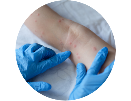 ronchas en piel